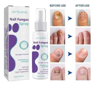 Gentle Nail Fungus Remover - Emirex