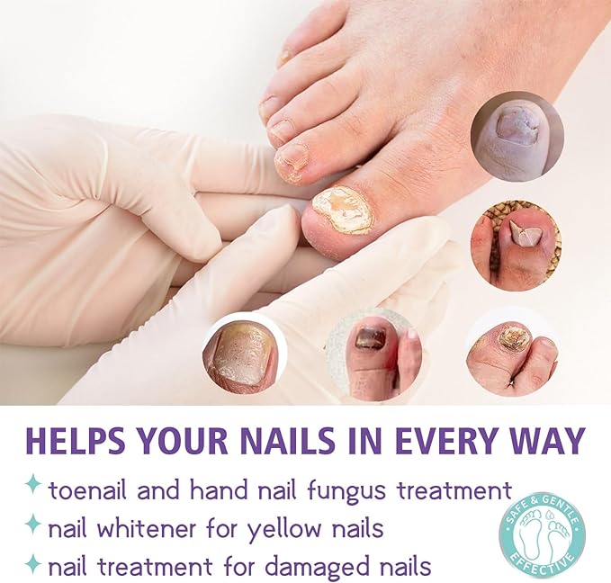 Gentle Nail Fungus Remover - Emirex
