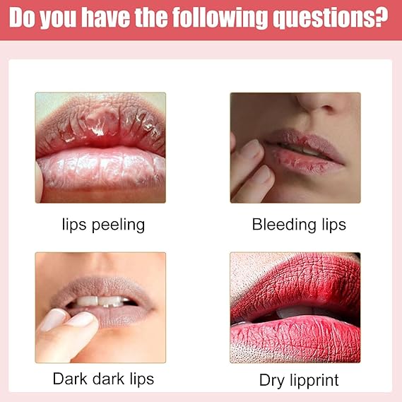 Lips Bleaching Cream Balm - Emirex