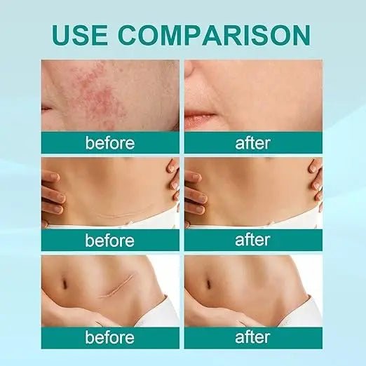 South Moon Scar Spray — سبراي ساوث مون لعلاج الندبات - Emirex