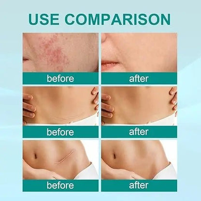 South Moon Scar Spray — سبراي ساوث مون لعلاج الندبات - Emirex